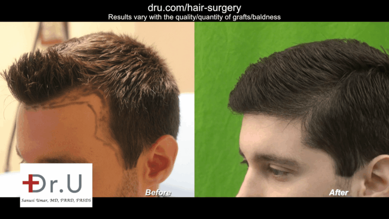 Los Angeles Young Age Hair Transplant Using Dr. UGraft: Before and After Aggressive Hair Line Lowering Los Angeles Young Age Hair Transplant Using Dr. UGraft: Before and After Aggressive Hair Line Lowering