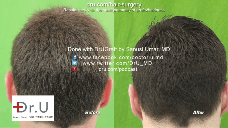 Back of Head Before and After Image - FUE Hairline Transplant Forehead Size Reduction Using 3200 Grafts Back of Head Before and After Image - FUE Hairline Transplant Forehead Size Reduction Using 3200 Grafts