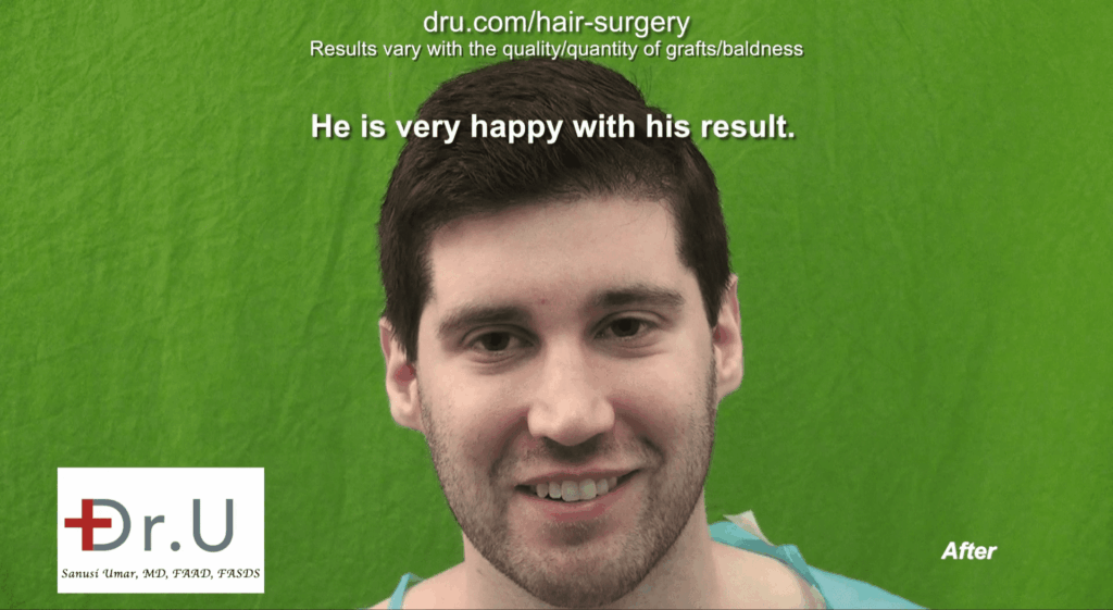 Patient Result Photo - Dr.UGraft Norwood 1 Forehead Size Reduction Hair Transplantation Patient Result Photo - Dr.UGraft Norwood 1 Forehead Size Reduction Hair Transplantation