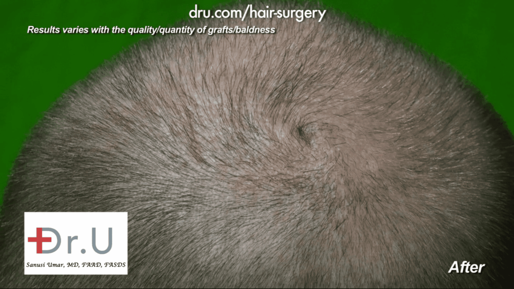 Dr. Umar matched the swirl pattern here while simultaneously improving the density of the hair already present. These DrUGrafts came from other areas of the head. 