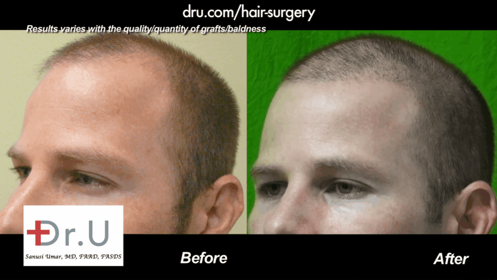 What is the best haircut after a less is more hair transplant?: This patient along with many others decided to sport a short buzz cut.