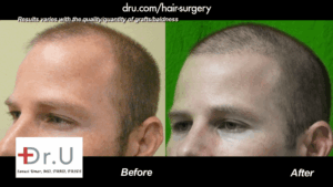 A hairline is now defined in this hair transplant patient of Dr. U in Redondo Beach.*