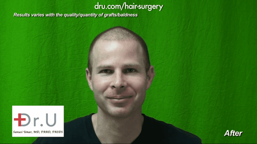 This patient is very happy with his transplant and healing process after hair transplant cost by less is more approach using Dr.UGraft