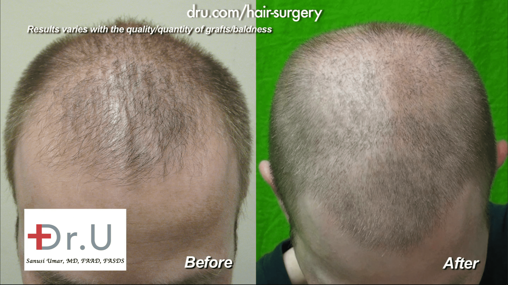How much is a good hair transplant? Hair restoration price is determined by the needs and goals of the patient and method used (such as a hair FUE).