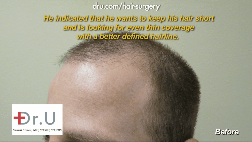 Patient wanted to know how to reduce hair transplant cost by less is more approach