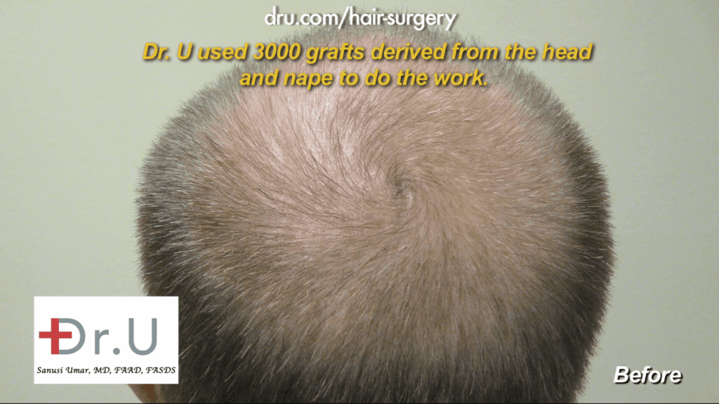 This patient's thinning hair is uneven. By using grafts from other areas of the head, Dr. Umar aimed to even out the patient's hair along the scalp. 