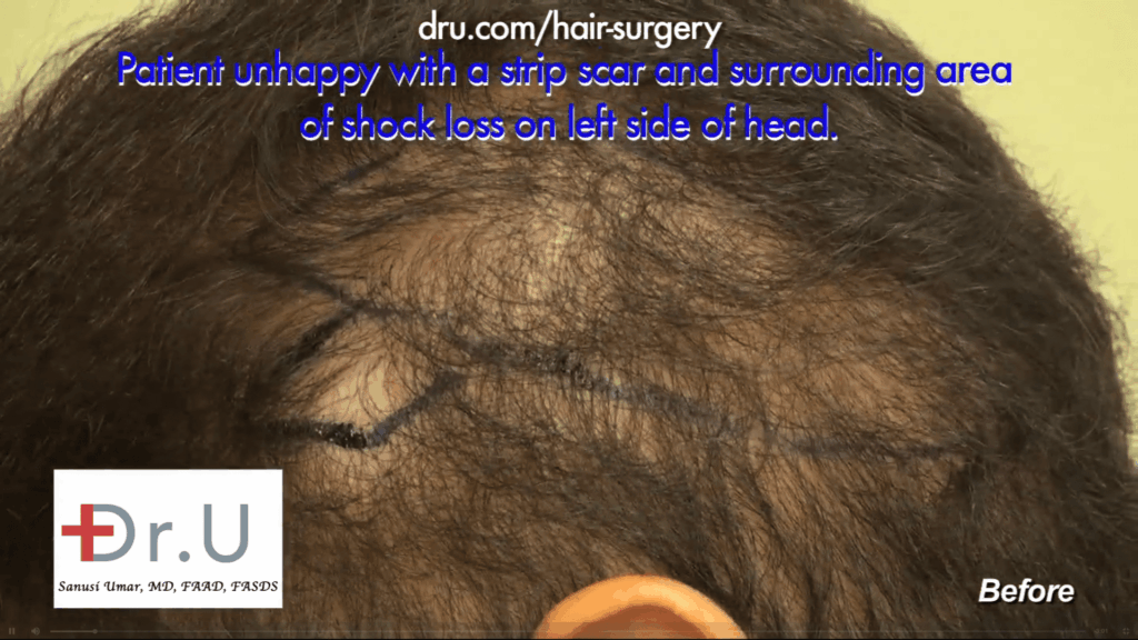 Donor area thinning near strip surgery scar - Patient with hair transplant donor area shock loss before repair by Dr U