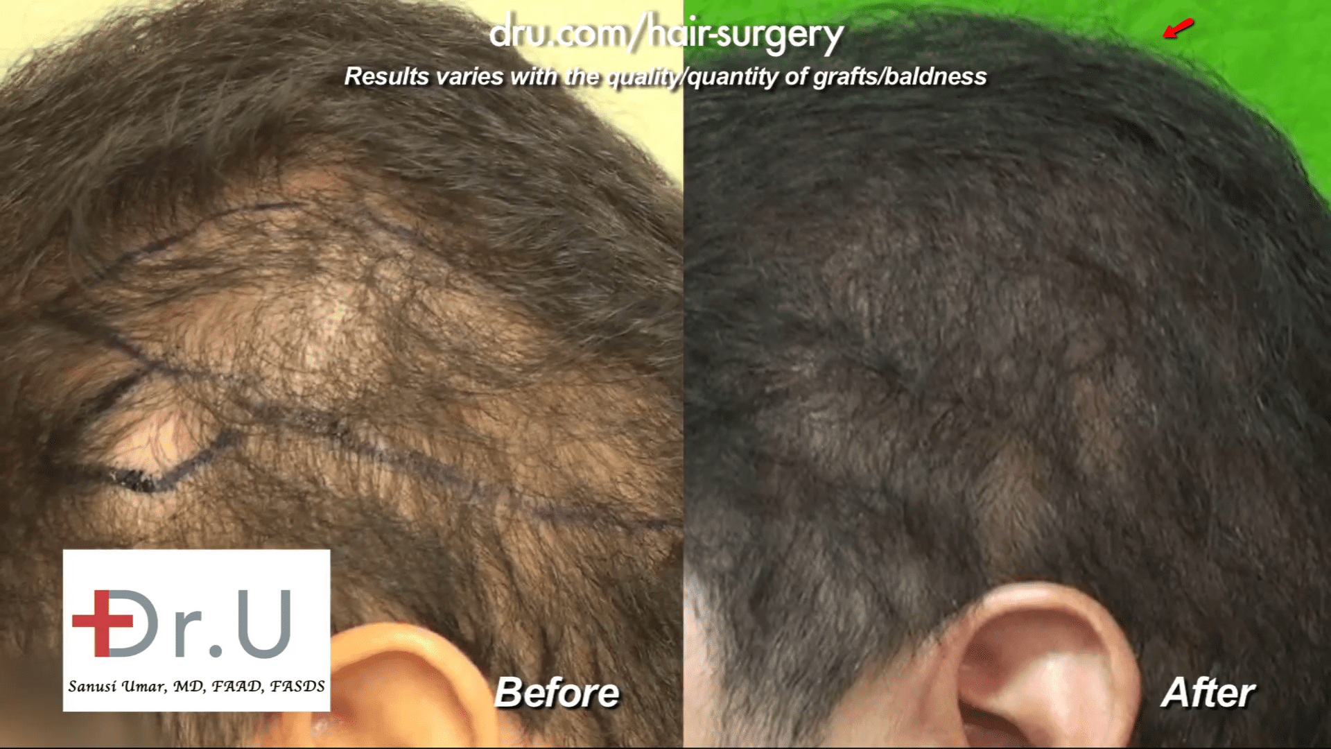 Shock loss resulted from past FUSS (Follicular Unit Strip Surgery) procedures. Beard donor hair was harvested using Dr.UGraft Advanced Follicular Unit Extraction procedures to restore the patient's coverage*
