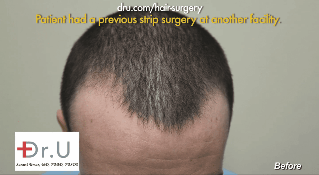 Follicular unit strip surgery Scar repair: patient before treatment