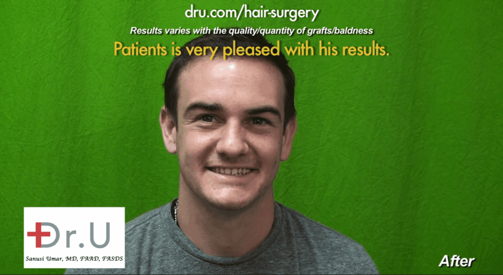Failed strip surgery hairline transplant repaired