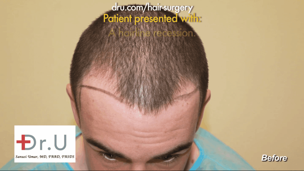 The patient and Dr. Umar to discover the ideal hairline that would match the patient's expectations.