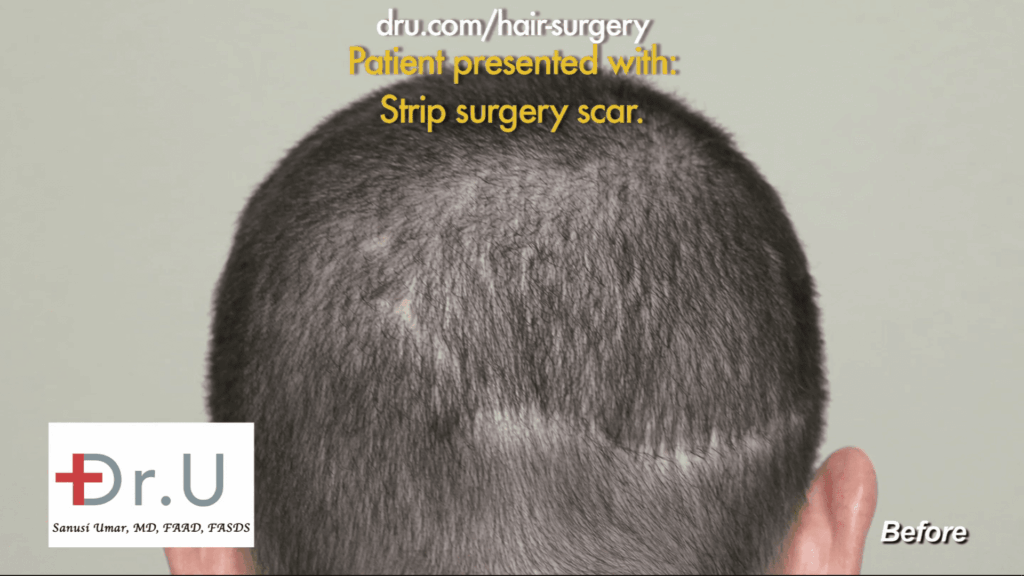 It was very important for the patient to conceal the scar from his previous strip surgery. This is the scar as it was presented to Dr. Umar
