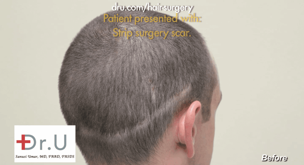The patient's results from his previous strip surgery with a different surgeon. His scarring is very visible along the back of the scalp.