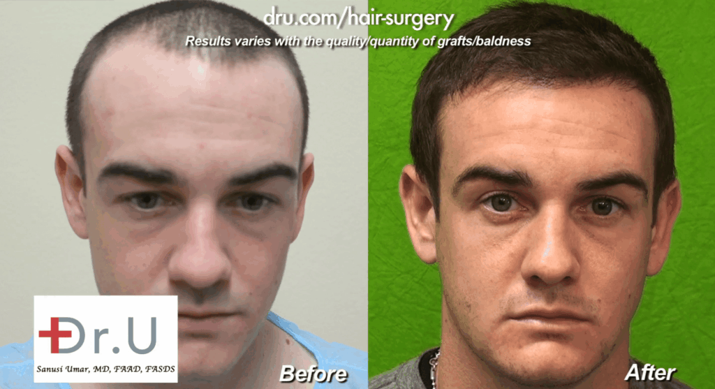 Hairline Restoration Before and After
