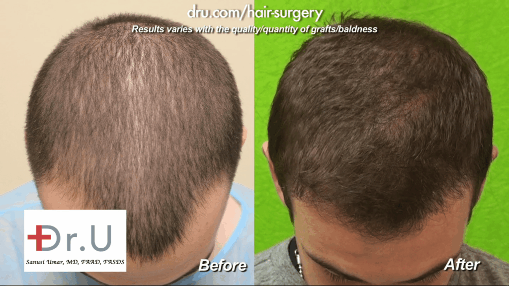 Failed strip surgery hairline transplant repair before and after photos