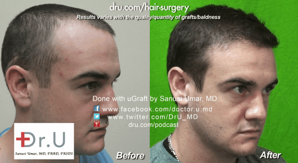Failed Hairline transplant restored: 1500 Dr.UGrafts were split between the patient's temple and along the strip surgery scar on the back of his head.
