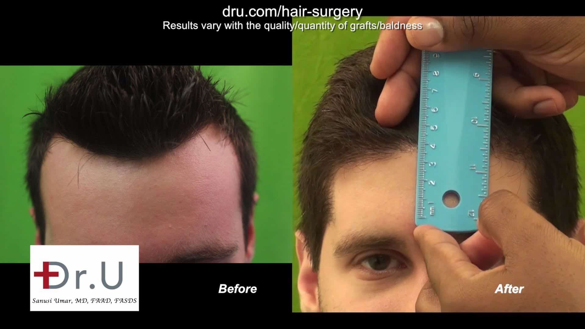 Hairline lowering procedure using the DrUGraft method.