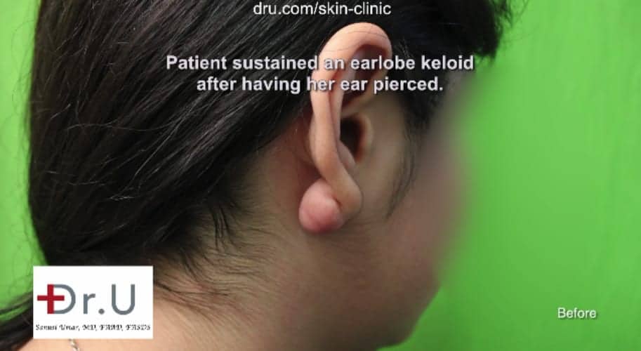 Dr U flap excision surgery to repair earlobe keloid A patient's keloid before Dr U flap excision surgery to repair earlobe keloid