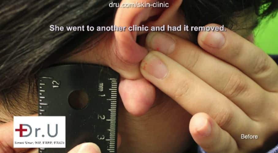 Dr U flap excision surgery to repair earlobe keloid Keloid after ear piercing and before Dr U flap excision surgery to repair earlobe keloid