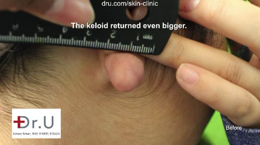 Dr U flap excision surgery to repair earlobe keloid Dr U flap excision surgery to repair earlobe keloid was necessary to correct excessive development of damaged tissue