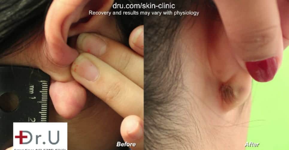 Before and after keloid removal - The Dr U flap excision surgery Before and after keloid removal - The Dr U flap excision surgery*