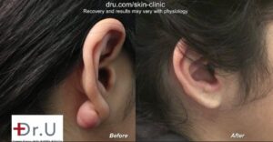 Flap excision surgery for keloids is an effective remedy