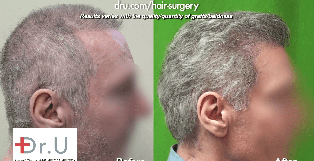 Before and After advanced FUE hair repair surgery