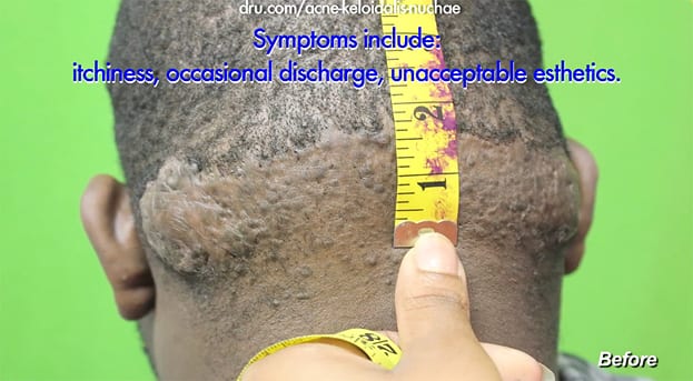 Before surgical treatment of Acne Keloidalis Nuchae mass by Dr U