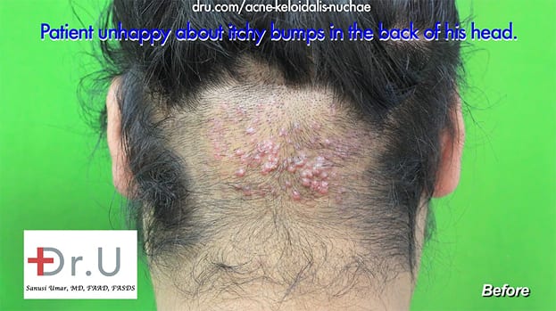 AKN Back of Neck Razor Bumps and zits before surgical cure by Dr U