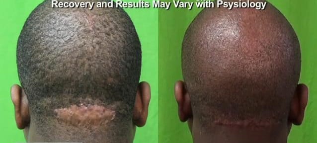 Dr U AKN Removal Surgery Scar Revision Before and After