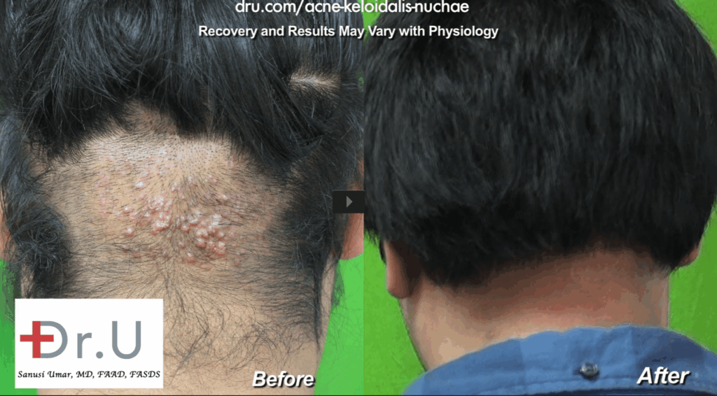 Dr Umar AKN Back of Neck Razor Bumps removal surgery results