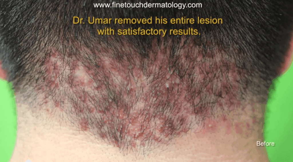 Acne keloidalis nuchae pimples in the back of the nape before surgical cure by Dr U Acne keloidalis nuchae pimples in the back of the nape before surgical cure by Dr U