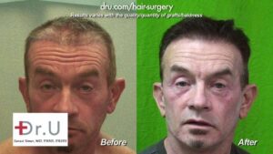 This patient in his 60's is very pleased with the new look of his hair after receiving a transplant by Dr. Umar and his advanced FUE technology.