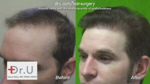 After a previous unsuccessful surgery, Dr. U created a Reworked Hairline and Temples with 1800 Dr UGrafts FUE for natural-looking results.
