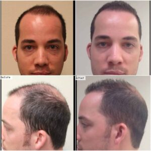 DrUGraft hair transplant using 1600 head grafts - before and after