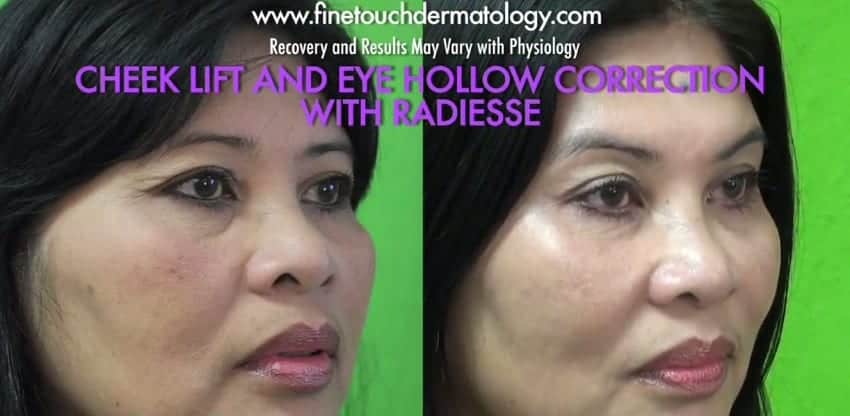 Before and after cheek lift and eye hollow correction with Radiesse treatment.