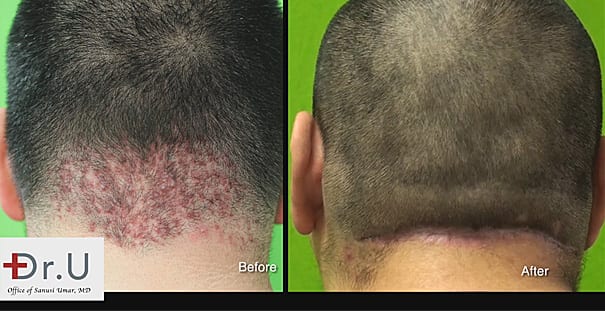 Back of Head Bumps Surgically Cured By Dr U - Before and after photo Back of Head Bumps Surgically Cured By Dr U - Before and after photo