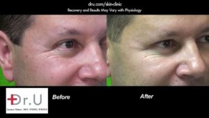 Before and after photo - Positive Patient Results Hours After Dysport Injections