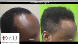 Before and after Curly African Hair FUE using DrUPunch Curl