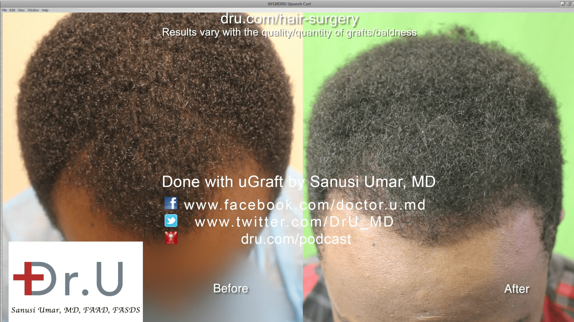 Black male hair transplant before and after. Black male hair transplant before and after.