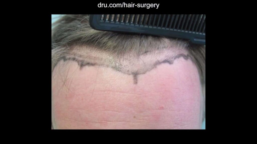 Dr. Umar worked to develop the preferred look with the patient.
