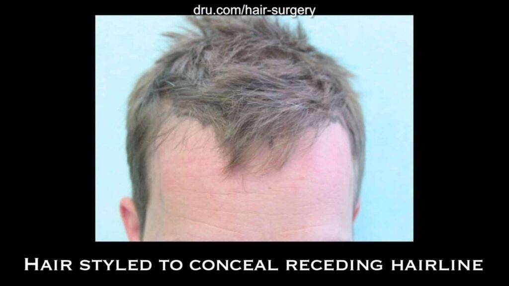 Hair loss forced this patient to keep his hair styled forward in order to camouflage his bald spot. This is an example of his hairstyle prior to receding hairline hair transplant with the Dr.UGraft.