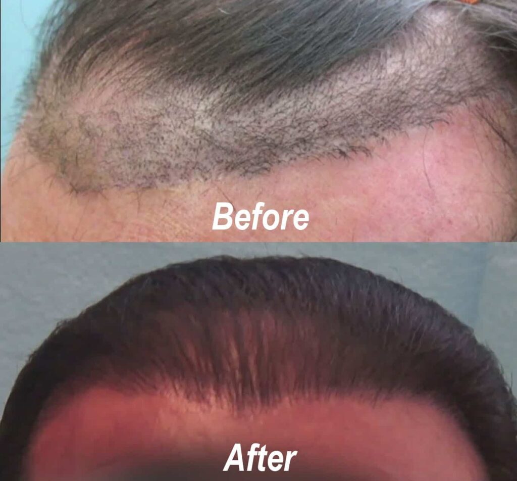 Juri Flap Surgery Problems Fixed- Before and After repair using the Dr.UGraft*
