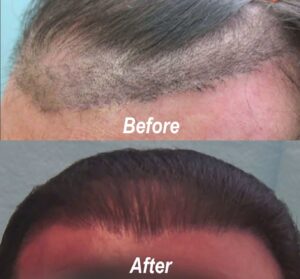 This patient had a very unnatural hairline after a juri hair flap surgery at a different clinic. The after photo shows how Dr. Umar created a much more natural hairline for this patient.*
