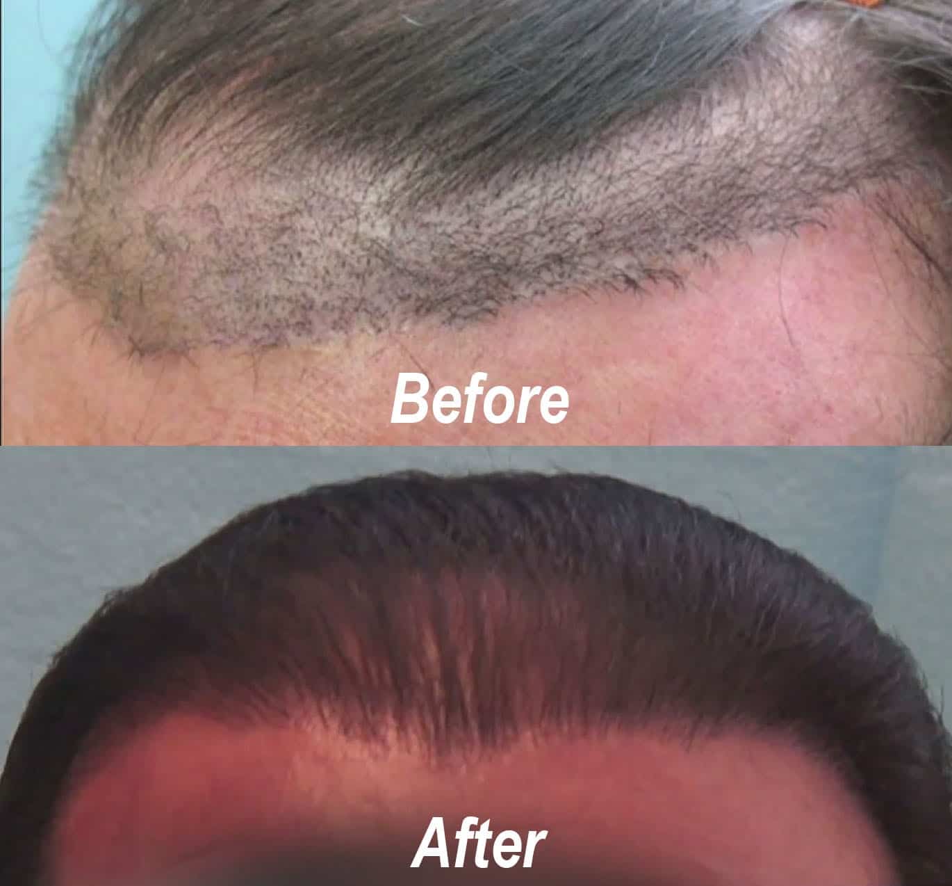This patient had a very unnatural hairline after a juri hair flap surgery at a different clinic. The after photo shows how Dr. Umar created a much more natural hairline for this patient.*