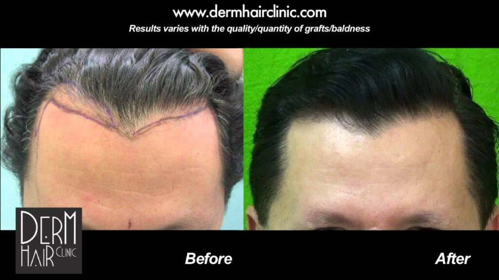 Graft count influencing cost of hair restoration: This Dr U patient with minor frontal hair loss needed only 600 grafts to meet his needs