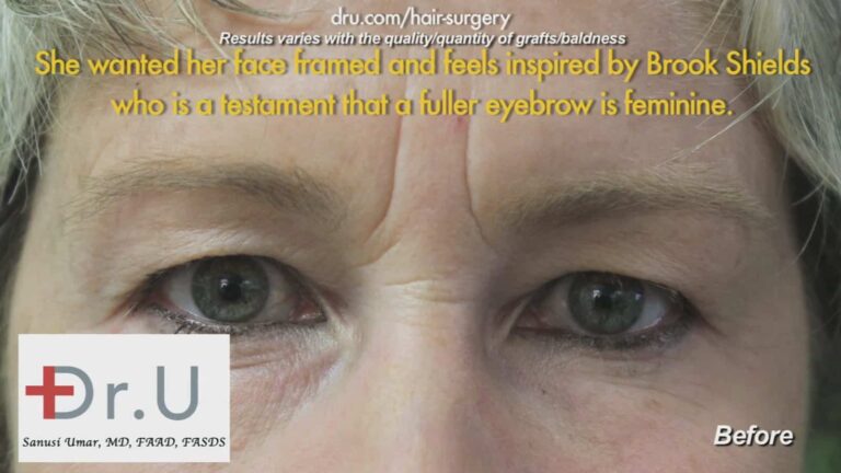 Before Eyebrow Hair Loss Treatment: Loss of hair before Dr.UGraft Before Eyebrow Hair Loss Treatment: Loss of hair before Dr.UGraft