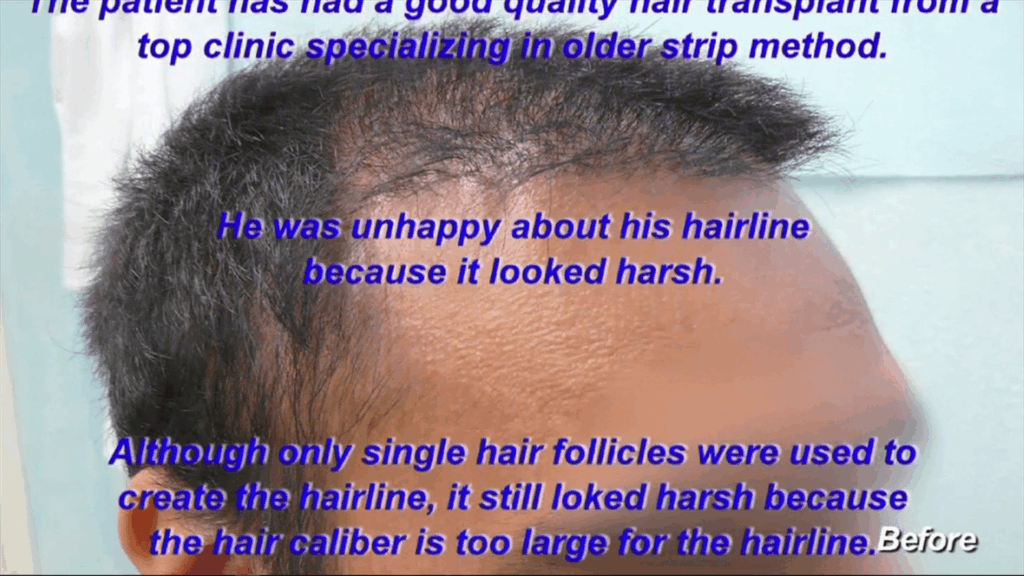 Previous surgery left a harsh hairline