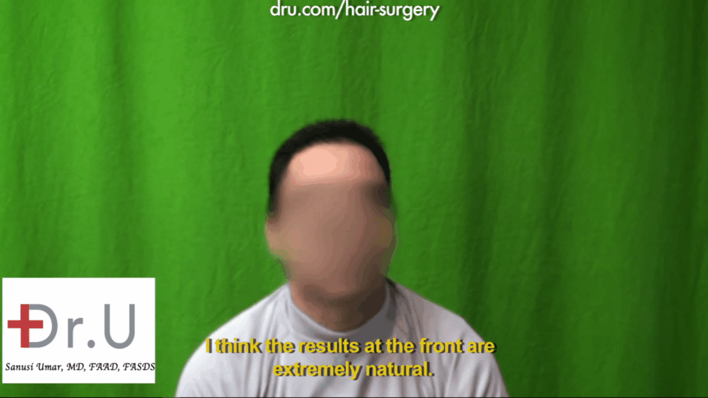 Hairline hair transplant: The patient received excellent results from the 1000 Dr.UGrafts repair of hairline after previous strip surgery.
