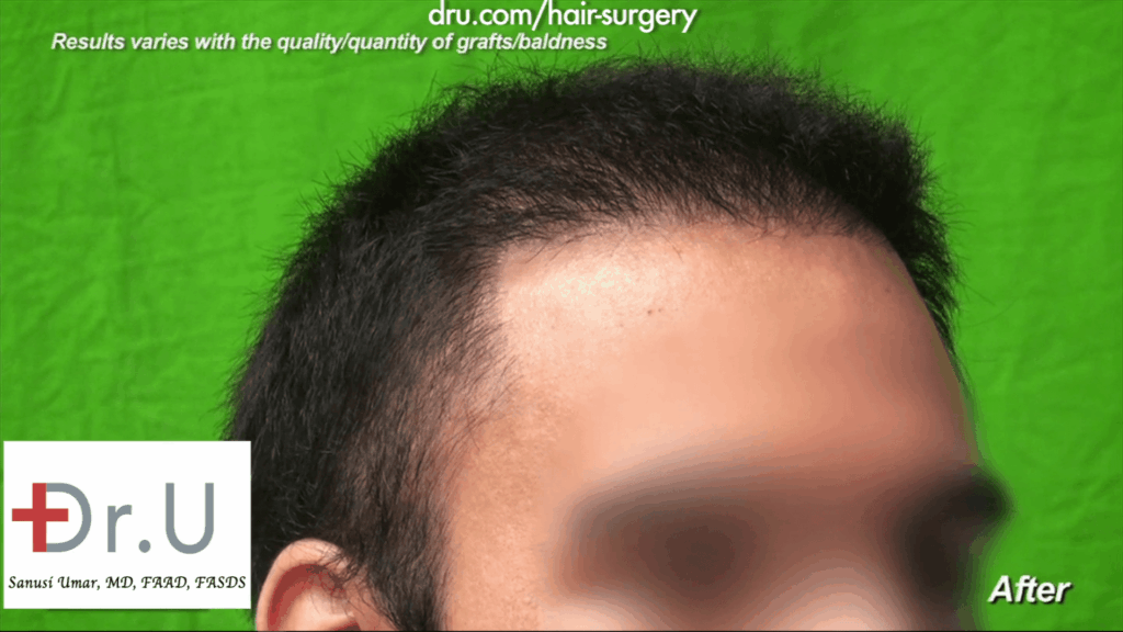Hair transplant hairline design: The hairline now has a natural flow